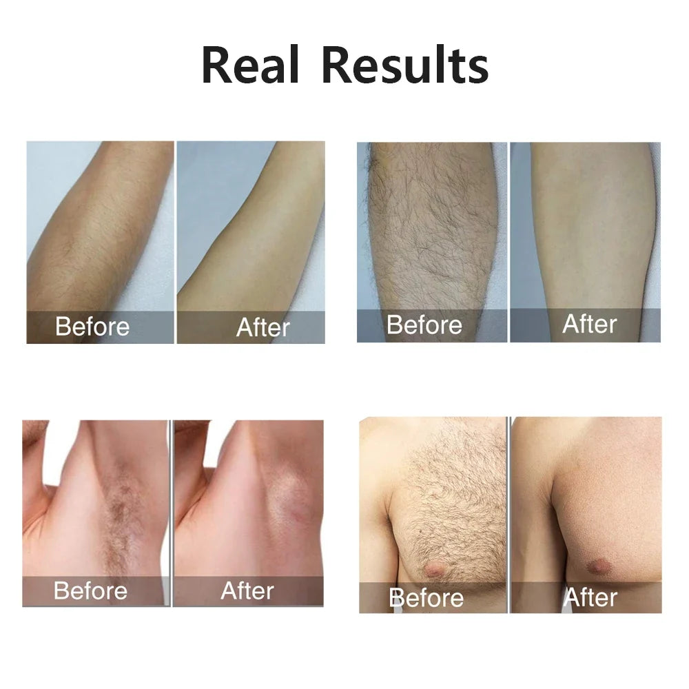 Hair Removal for Women – 999999 Flashes Painless Laser Epilator for Face, Body & Bikini Line